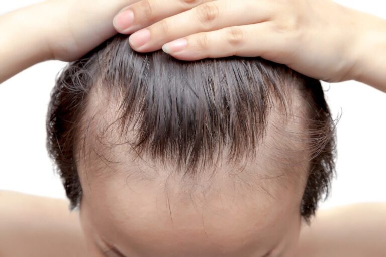 Man-pulling-hair-back-to-reveal-receding-hairline-1024x683