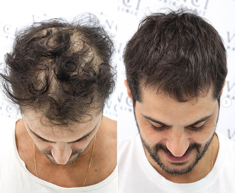 Why-Stress-Makes-Hair-Loss-Worse