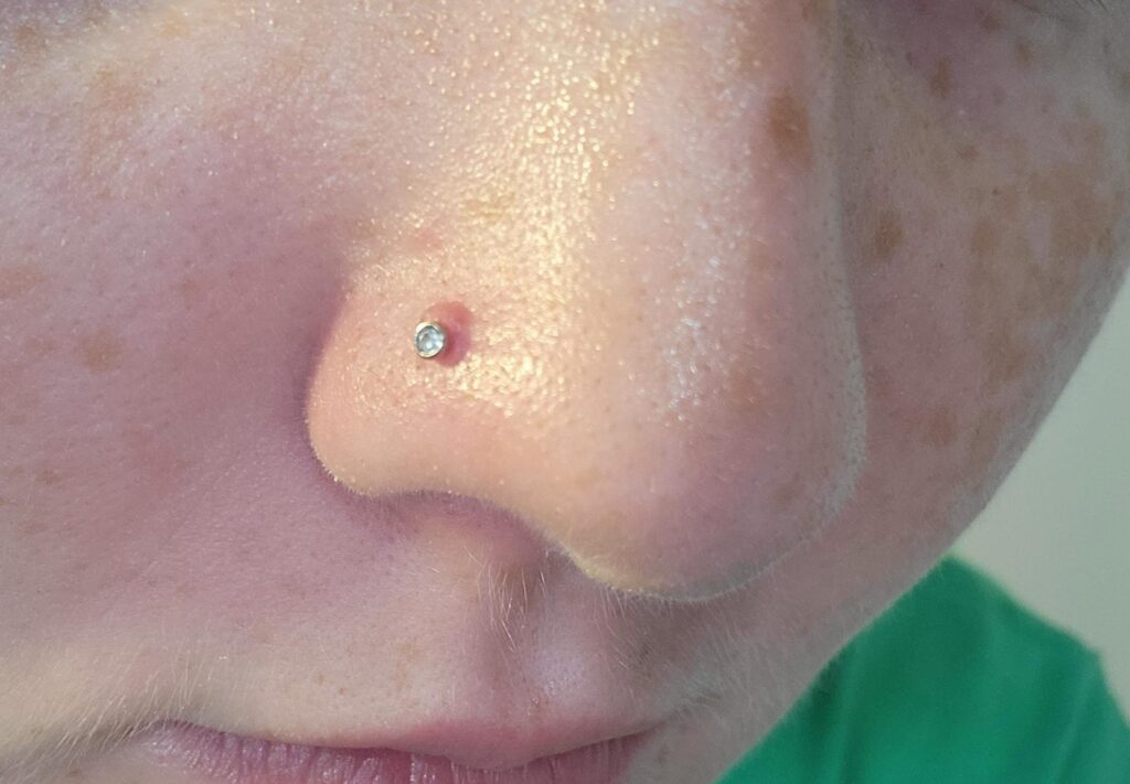 the-dreaded-nose-bump-ugh-any-help-besides-what-ive-already-v0-u1wh1iqwe2sb1