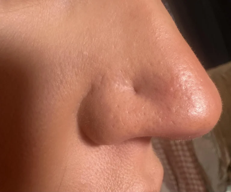 will-microneedling-help-with-my-nose-piercing-scar-v0-6ywxzvp5szpf1