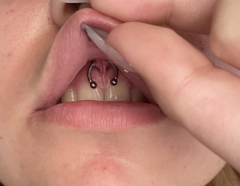 is-smiley-piercing-harmful-to-gums